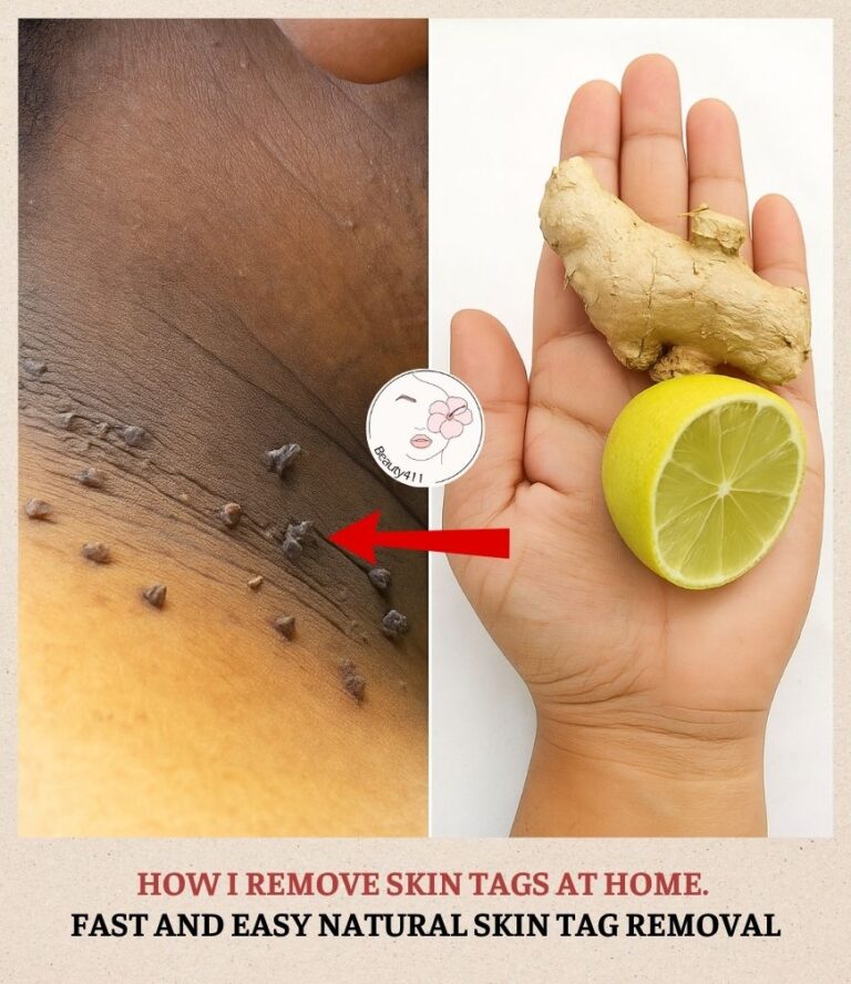 8 Amazing Benefits of Using Lemon and Ginger to Remove Skin Tags