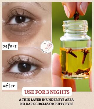 Beat Dark Circles, Sunken, And Puffy Eyes With These Remedies