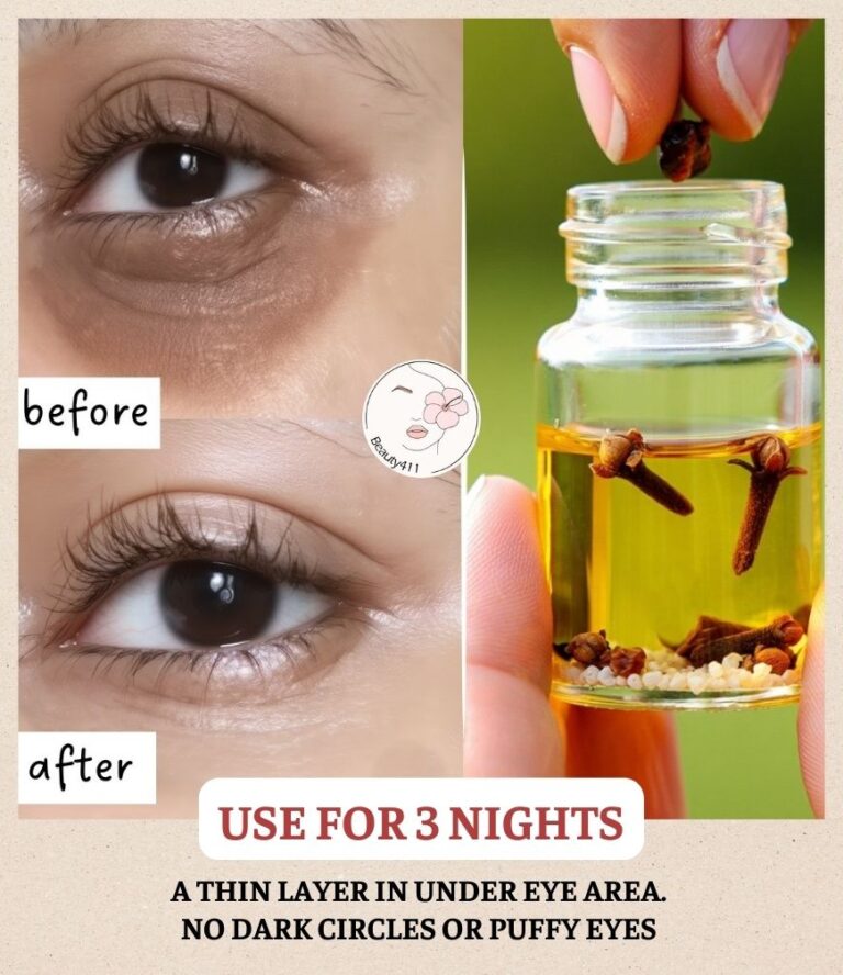 Beat Dark Circles, Sunken, And Puffy Eyes With These Remedies