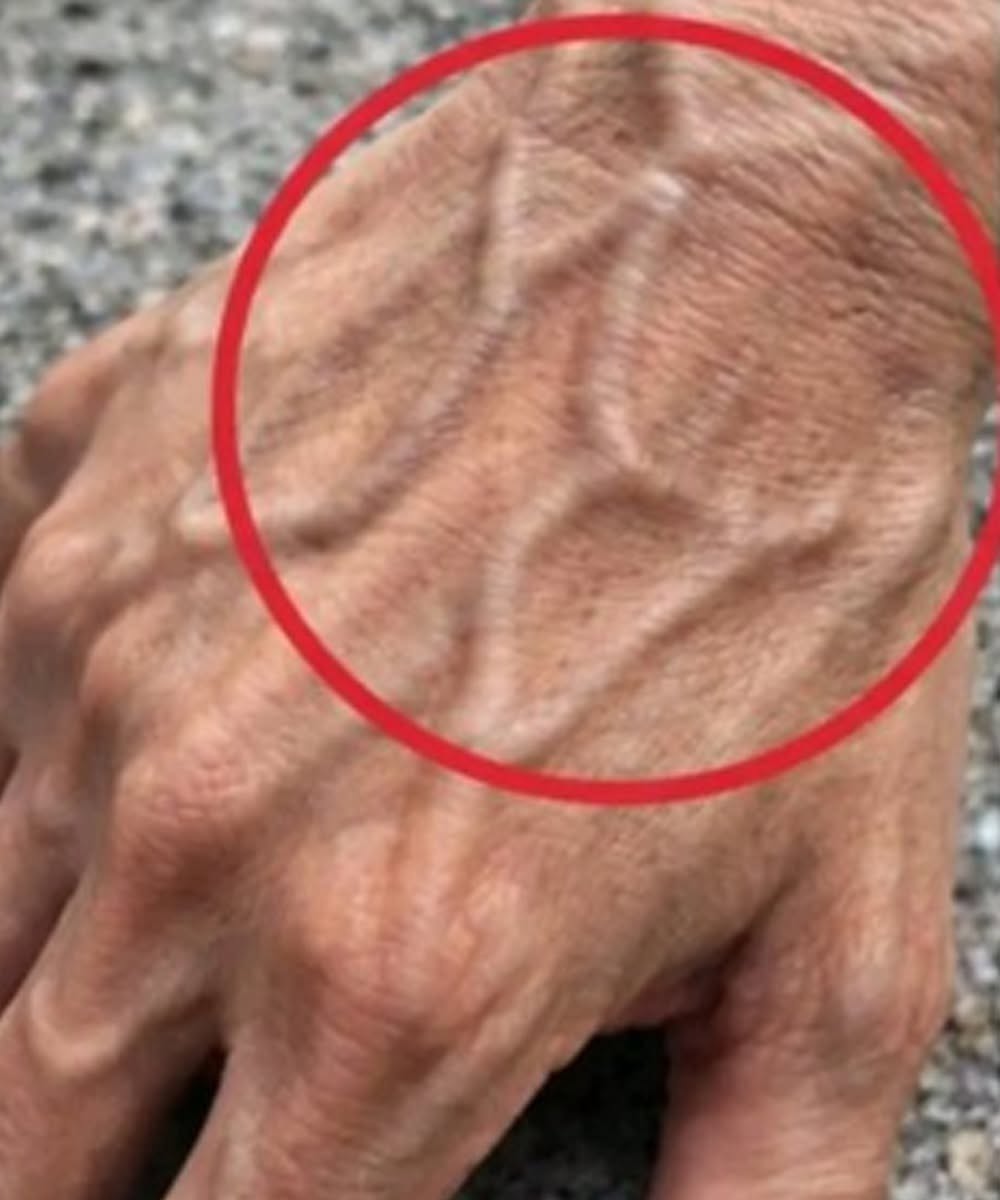 💙 If You Have Visible Veins, What Does It Really Mean?