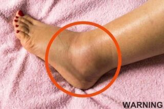 If You Notice Your Legs Are Swollen, Doctors Warn It Could Be a Sign of